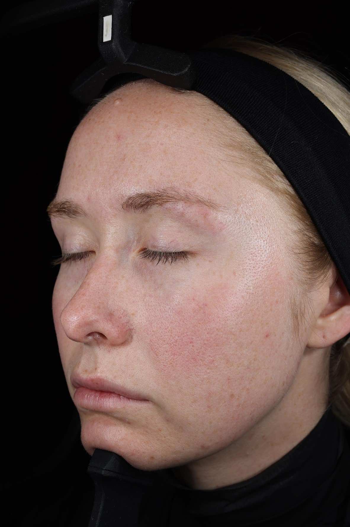 SkinPen Recovery - Before