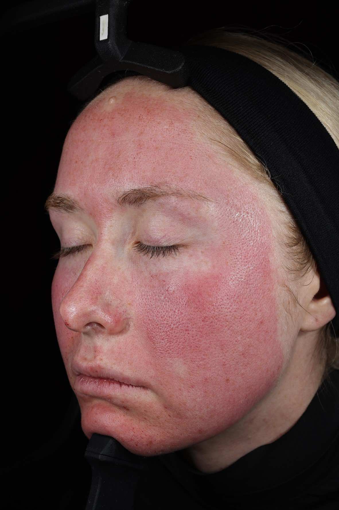 SkinPen Recovery - 1 Hour