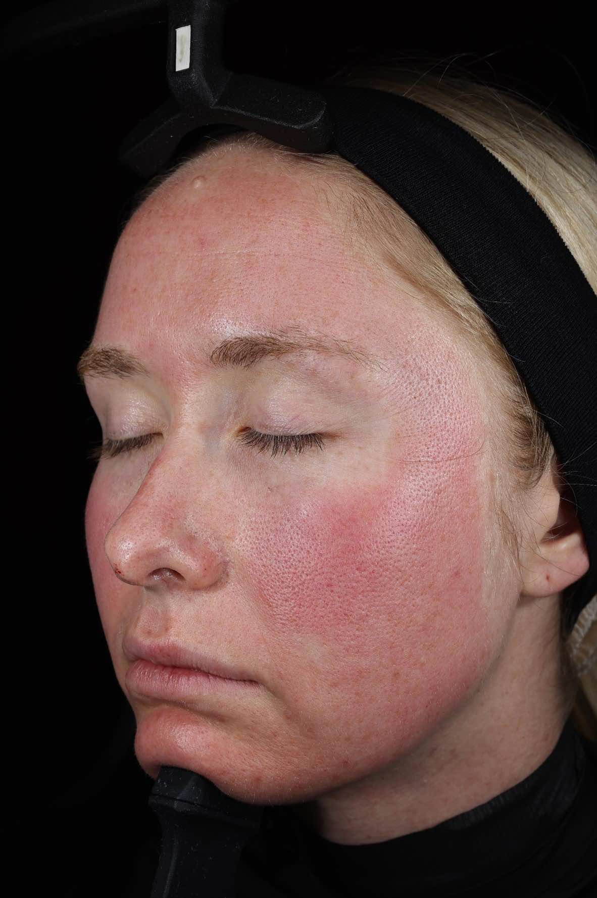 SkinPen Recovery - 4 Hours